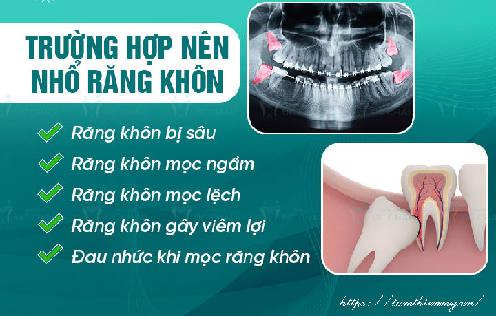 nhổ răng khôn có đau không