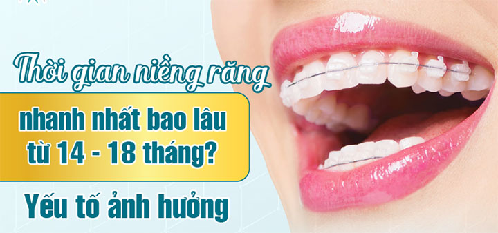 Niềng răng nhanh nhất là bao lâu