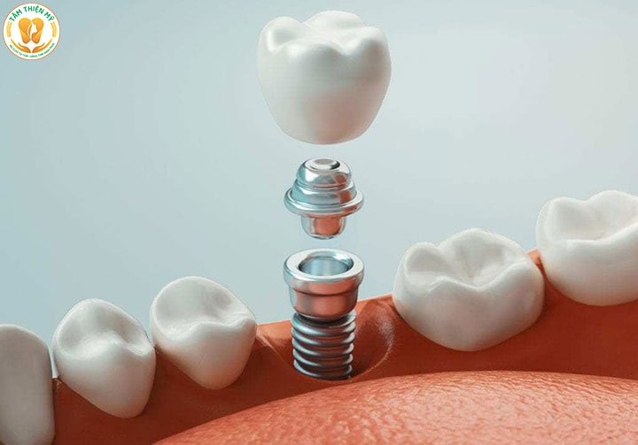 Bảng giá trồng răng Implant 2026 tại Hưng Yên