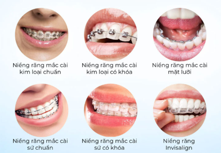 các phương pháp niềng răng