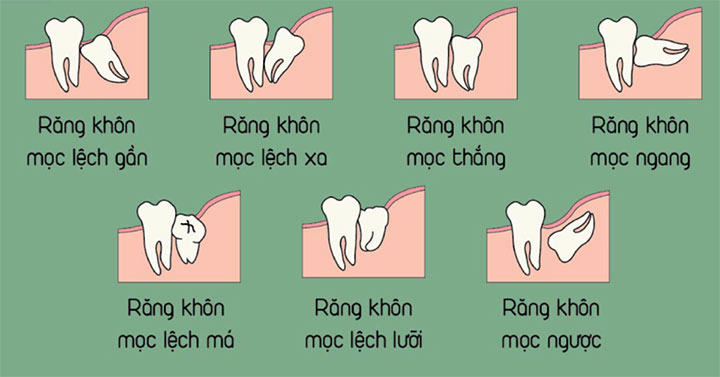 Răng số 8 có nên nhổ không