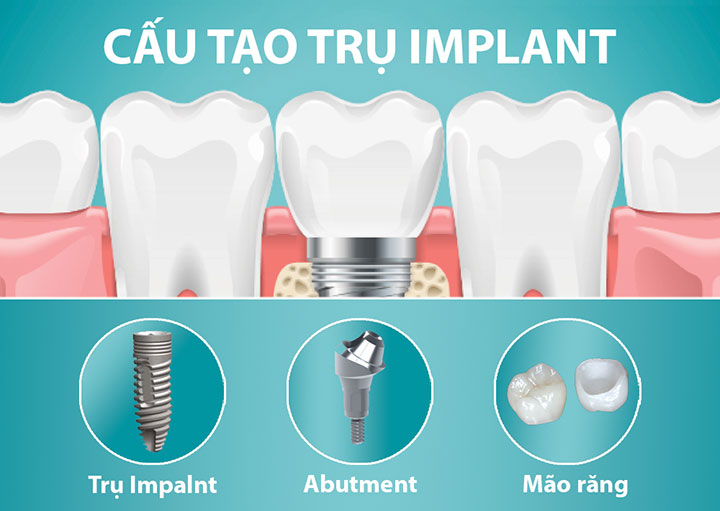 Răng implant làm bằng