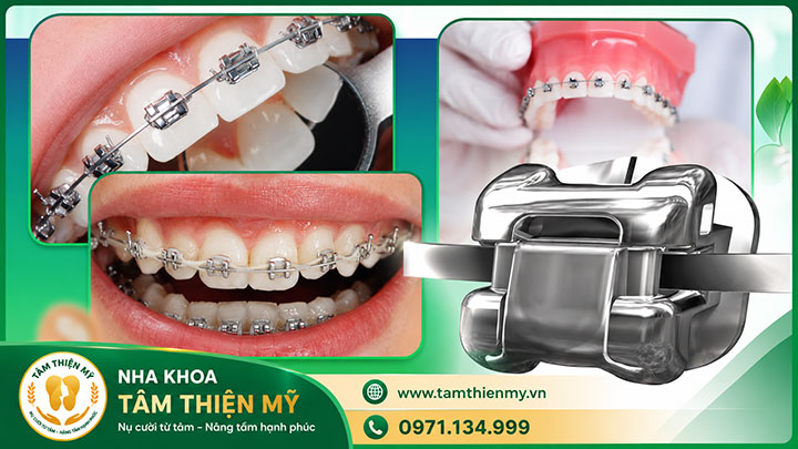 địa chỉ niềng răng uy tín tại hưng yên