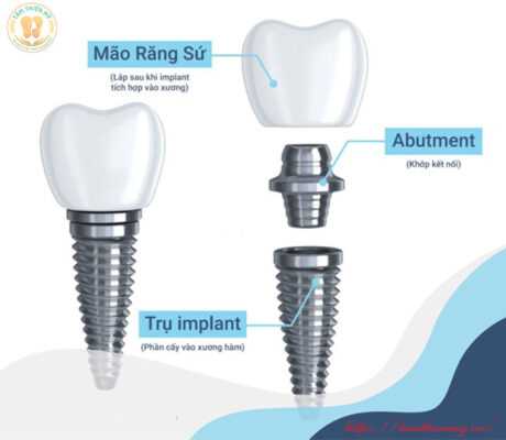 giá trồng răng Implant
