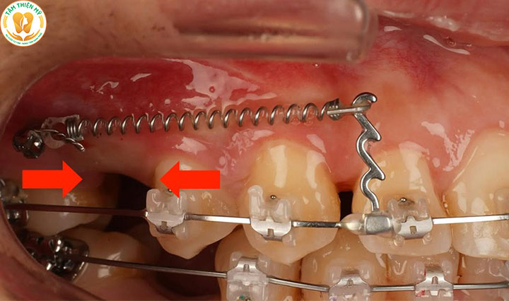 Lợi ích của niềng răng