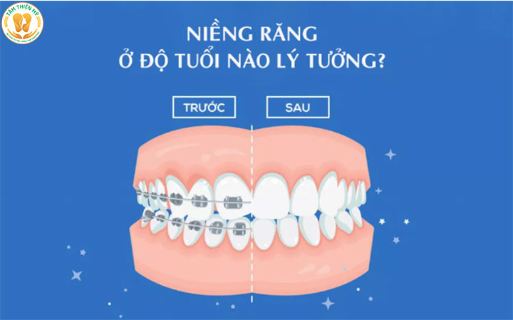 nên niềng răng ở độ tuổi nào