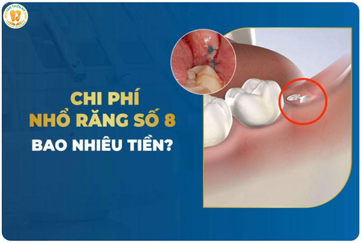 Răng số 8 nhổ bao nhiêu tiền