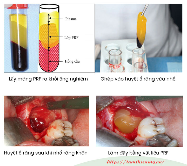 Nhổ răng khôn huyết tương giàu tiểu cầu