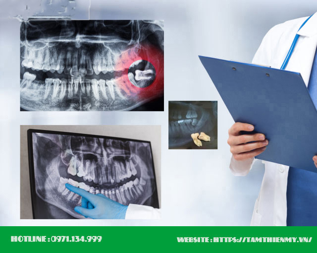 Răng số 8 có phải nhổ không