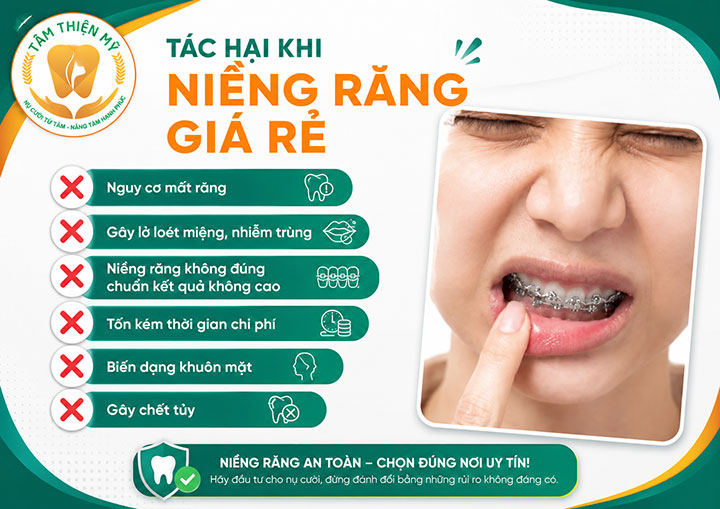 Chi phí niềng răng giá rẻ