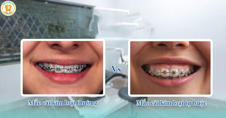 mắc cài kim loại có mấy loại