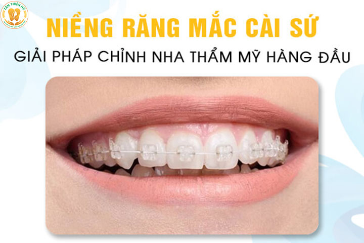 niềng răng mắc cài sứ