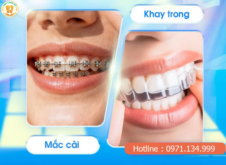 niềng răng tiếng anh là gì