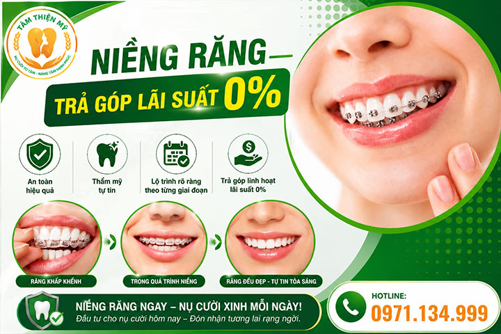 niềng răng trả góp