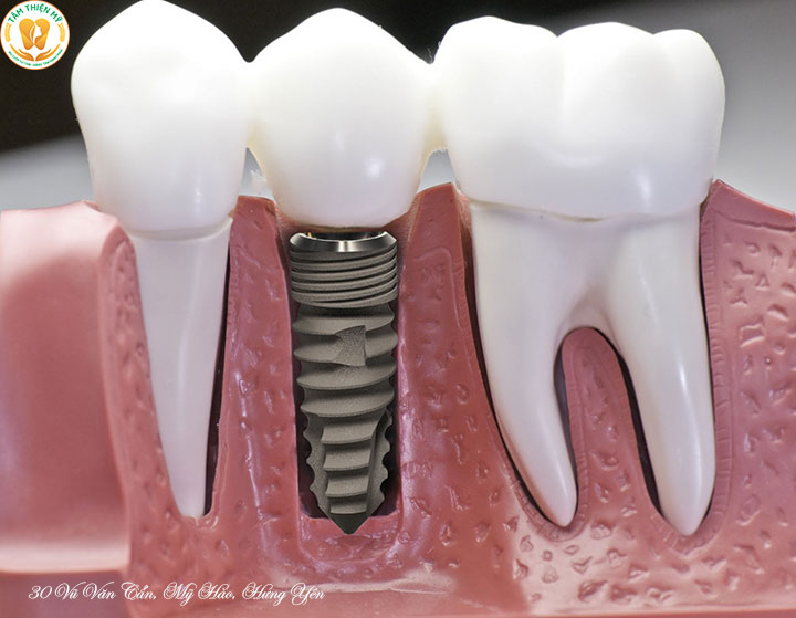 giá trồng răng Implant