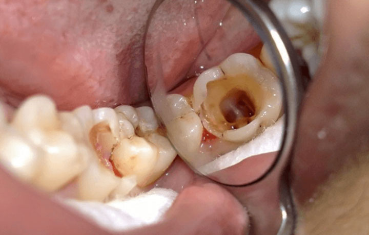 Răng số 8 bị sâu có nên nhổ không