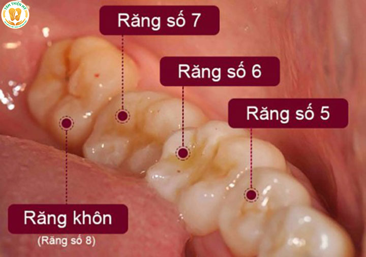 Răng khôn là răng hàm số mấy