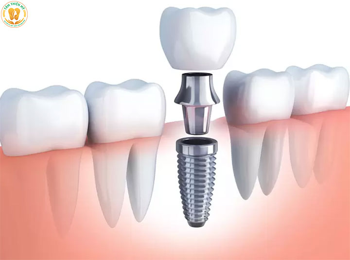 Trồng răng Implant là gì