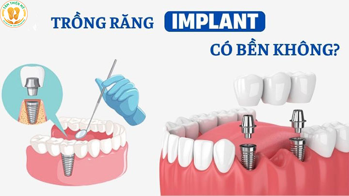 Răng implant làm bằng