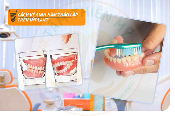 Cách vệ sinh hàm tháo lắp trên Implant