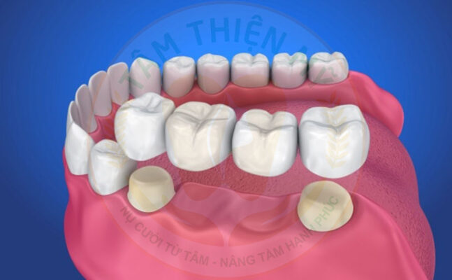 Trồng răng giả bằng cầu răng sứ