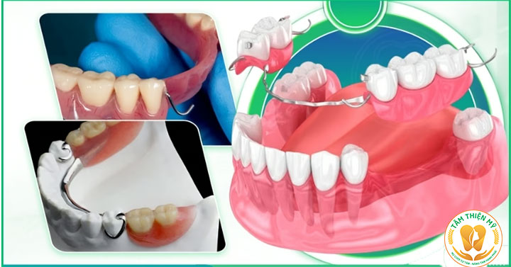 Cấy Implant toàn hàm và hàm tháo lắp phương án nào tối ưu? 2 Hàm tháo lắp Removable Dentures
