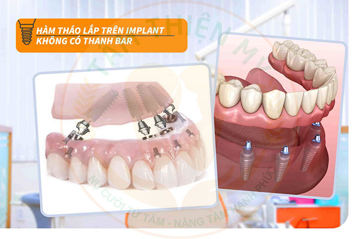 Hàm tháo lắp trên Implant không có thanh bar