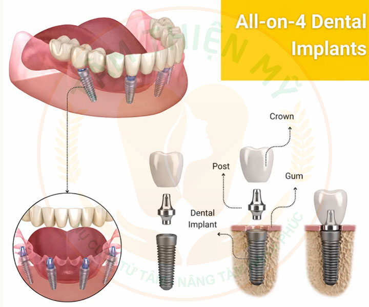 cấy ghép Implant All-on-4 tại Tâm Thiện Mỹ
