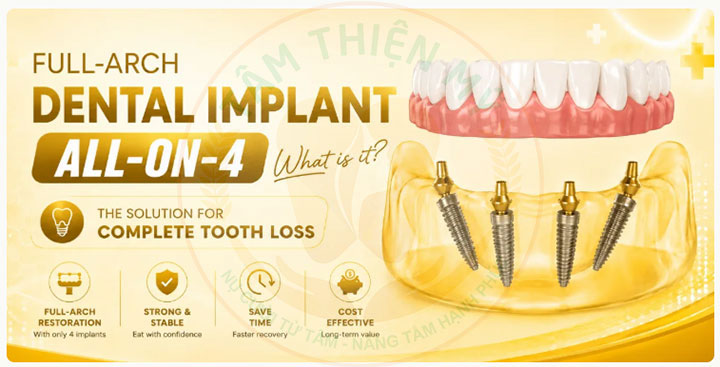 cấy ghép Implant All-on-4 tại Tâm Thiện Mỹ