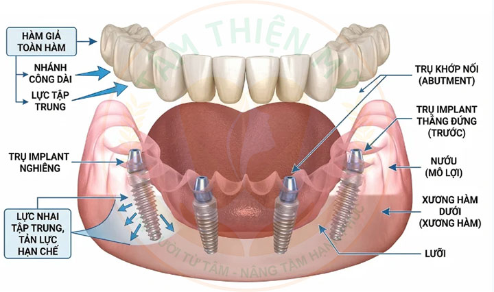 cấu tạo implant all-in-4