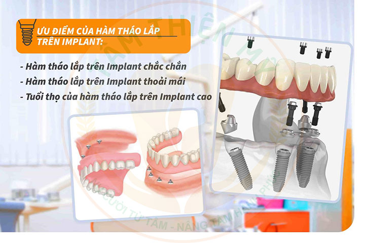 ưu điểmhàm tháo lắp trên Implant