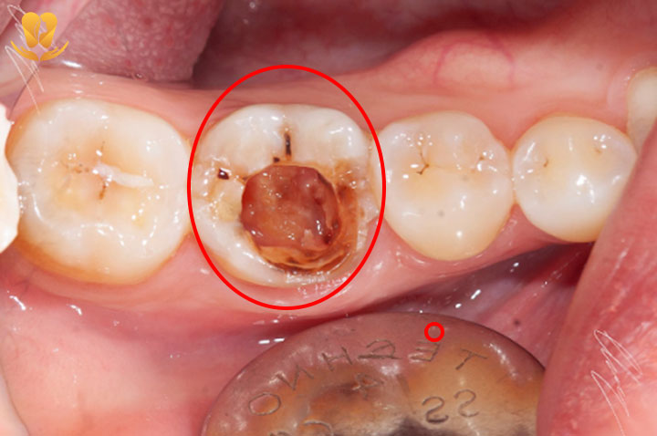 cấy implant tức thì