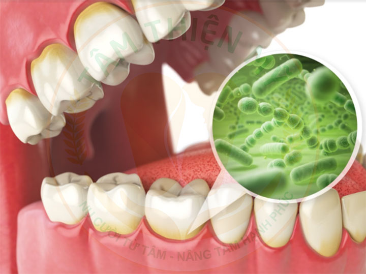 Răng implant lung lay - nguyên nhân - giải pháp khắc phục triệt 4 Răng Implant lung lay do chăm sóc răng miệng