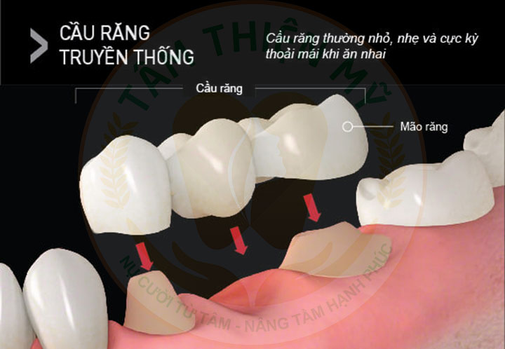 Bắc cầu răng sứ là gì? Phân loại - Ưu - nhược điểm của cầu răng sứ 2 Bắc cầu răng sứ là gì cầu răng sứ tiếng anh là gì