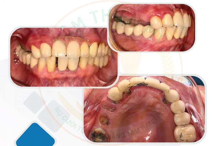 nhược điểm của bắc cầu răng sứ