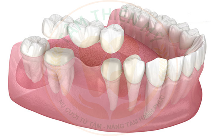 So sánh cầu răng và Implant nên chọn loại nào? 5 cầu răng sứ