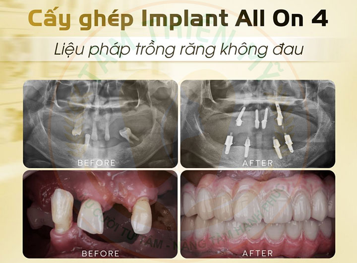 cấy ghép Implant  All-on-4