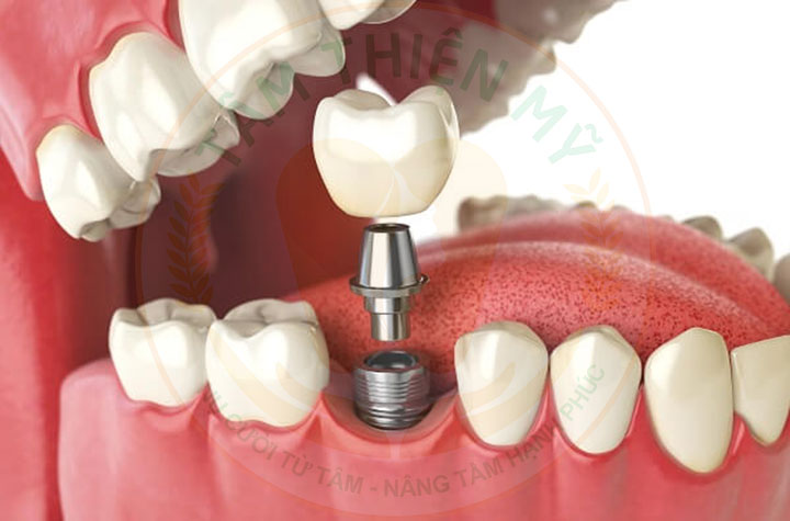 So sánh cầu răng và Implant nên chọn loại nào? 6 cấy ghép implant