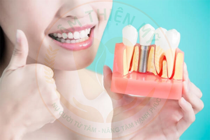 Cấy Implant toàn hàm và hàm tháo lắp phương án nào tối ưu? 4 cấy ghép implant uy tín hưng yên