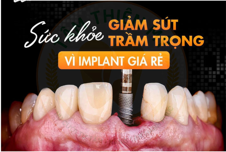 rủi ro cấy implant giá rẻ