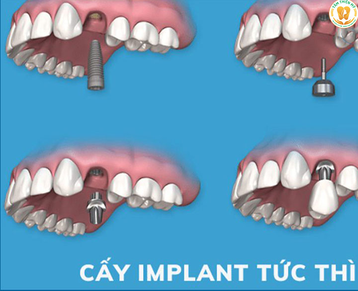 cấy implant tức thì