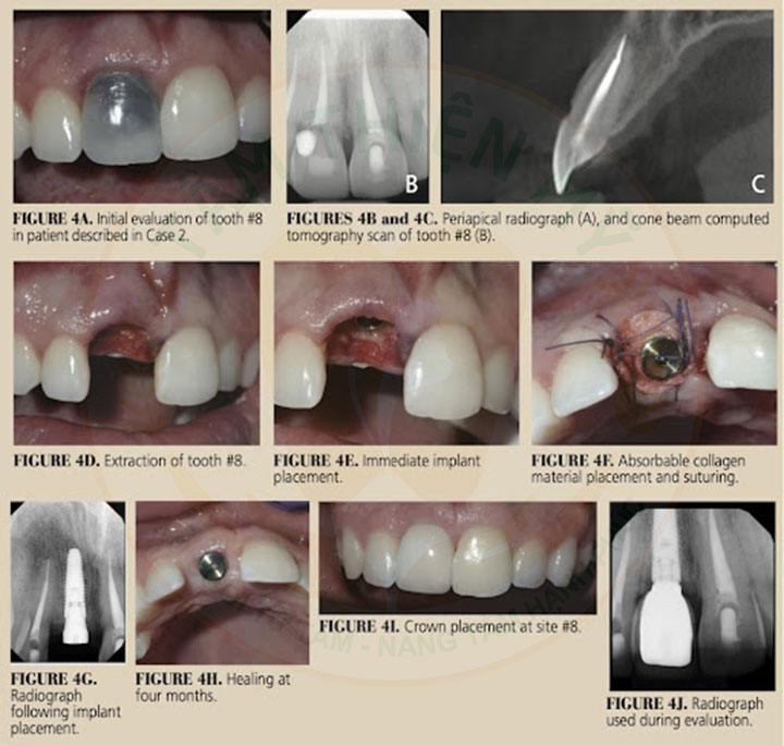 cấy ghép implant công nghệ chịu lực tức thì tại Nha khoa Tâm Thiện Mỹ