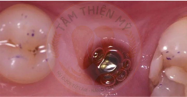 hậu quả cấy implant giá rẻ