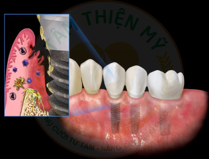 răng implant bị chảy máu kéo dài