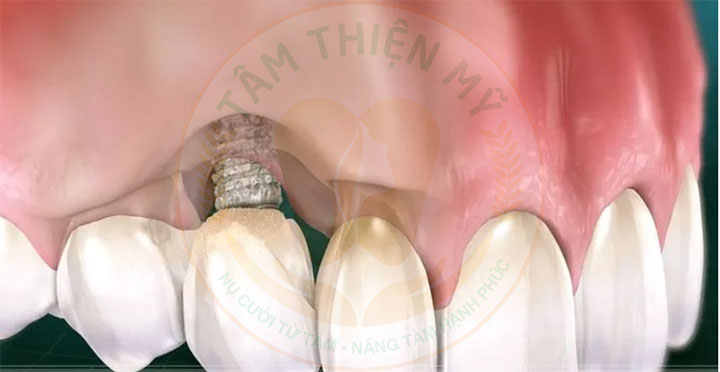 đào thải trụ implant