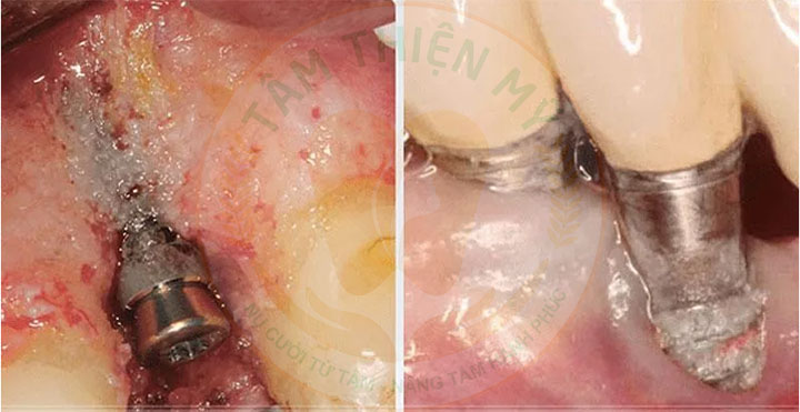 Đào thải trụ Implant