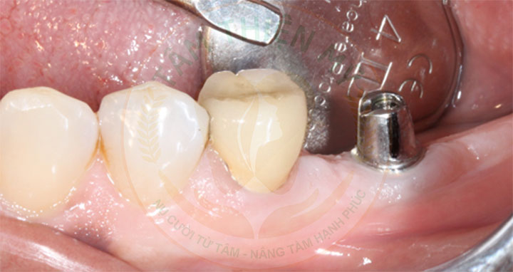 đặt trụ implant