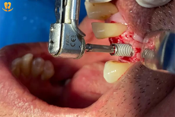 phẫu thuật đặt trụ implant