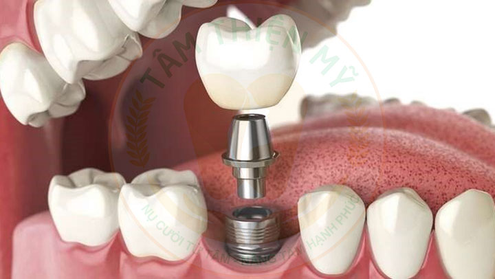 dấu hiệu Implant bị đào thải
