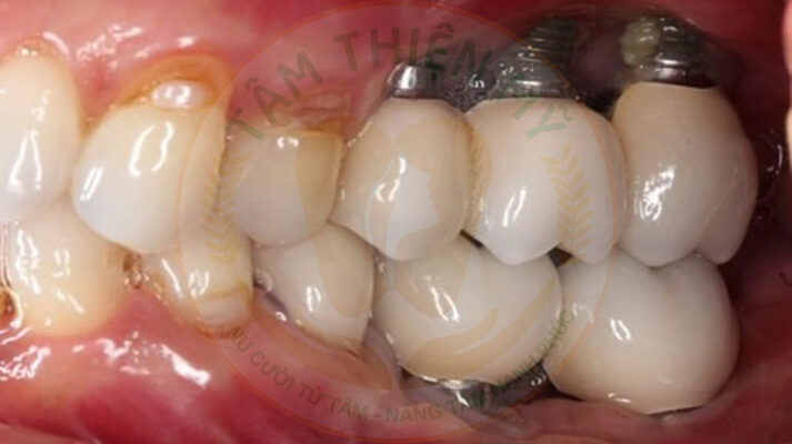 Trụ Implant bị đào thải có nguy hiểm không